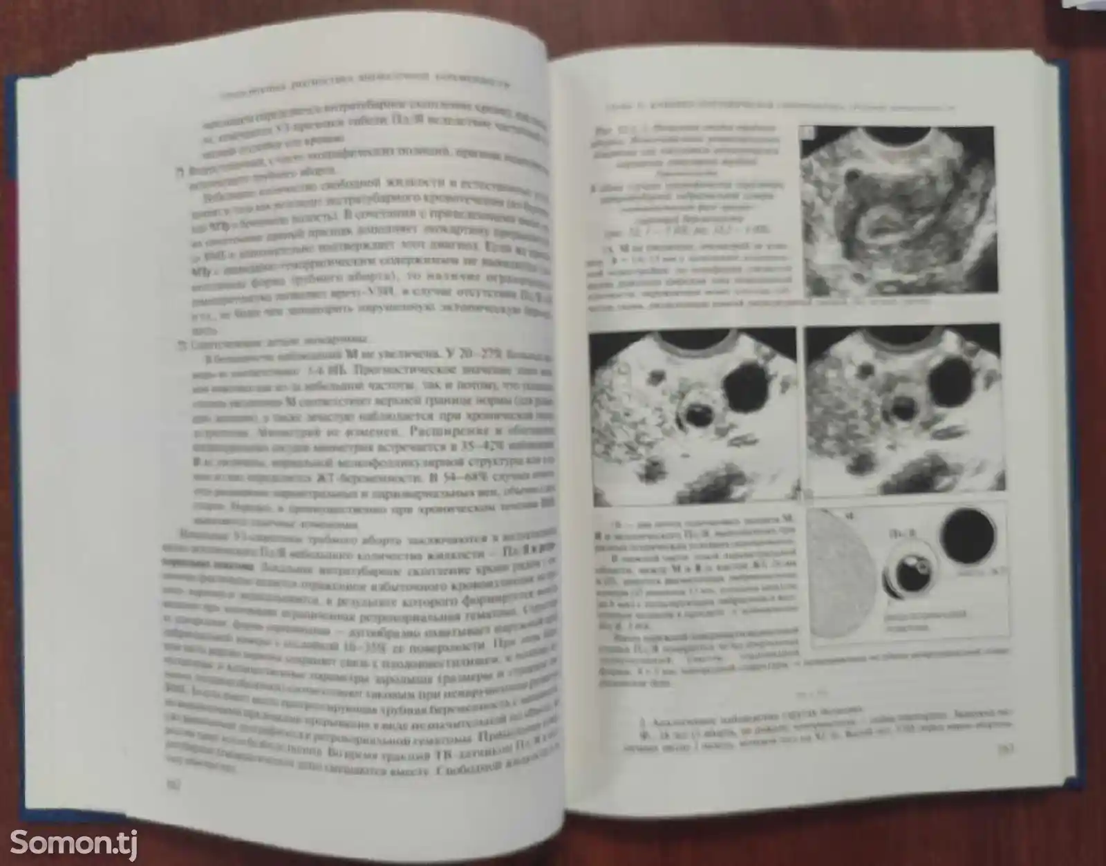 Ультразвуковая диагностика внематочной беременности-5