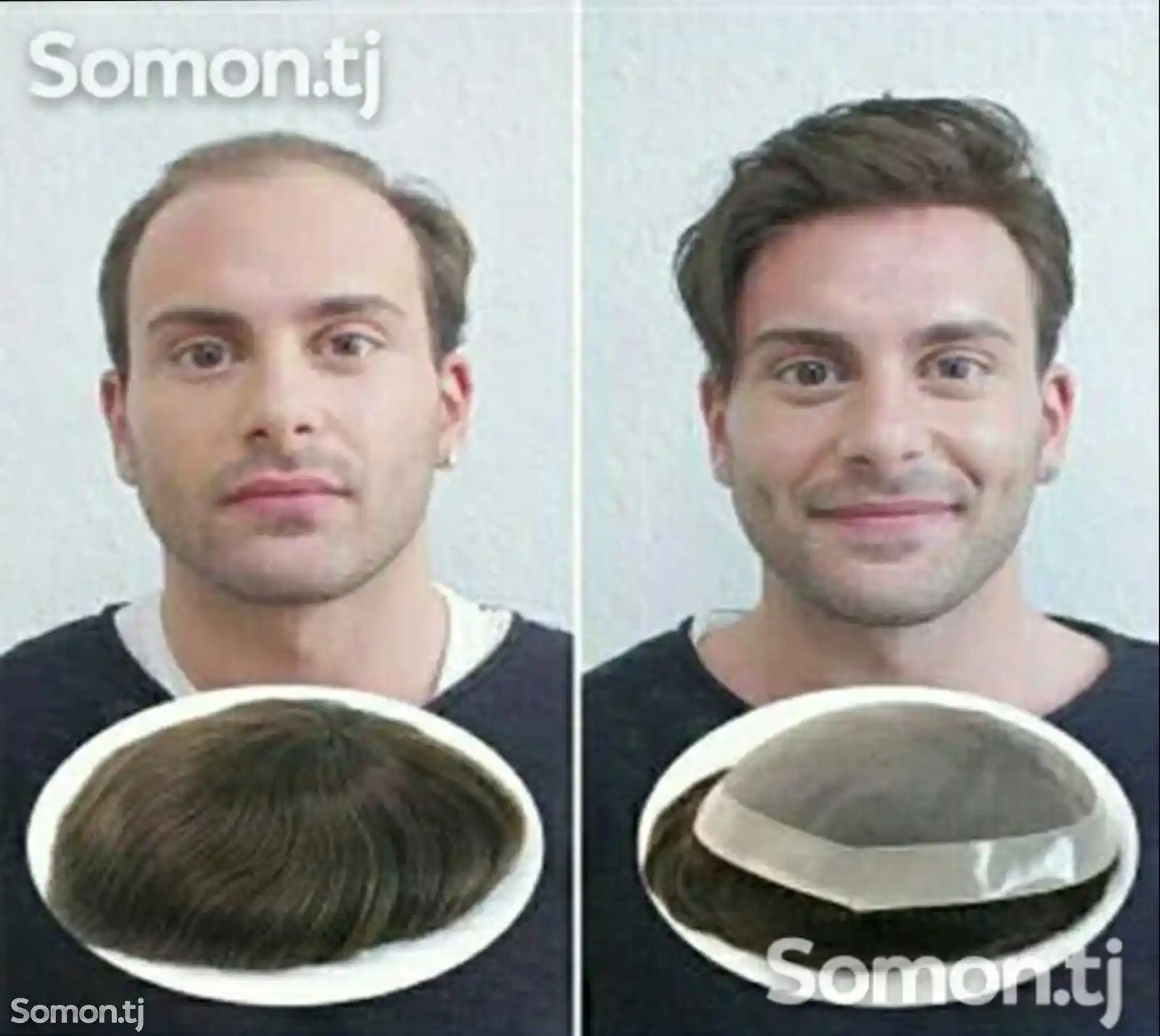 Услуга по наращиванию волос для мужчин-3