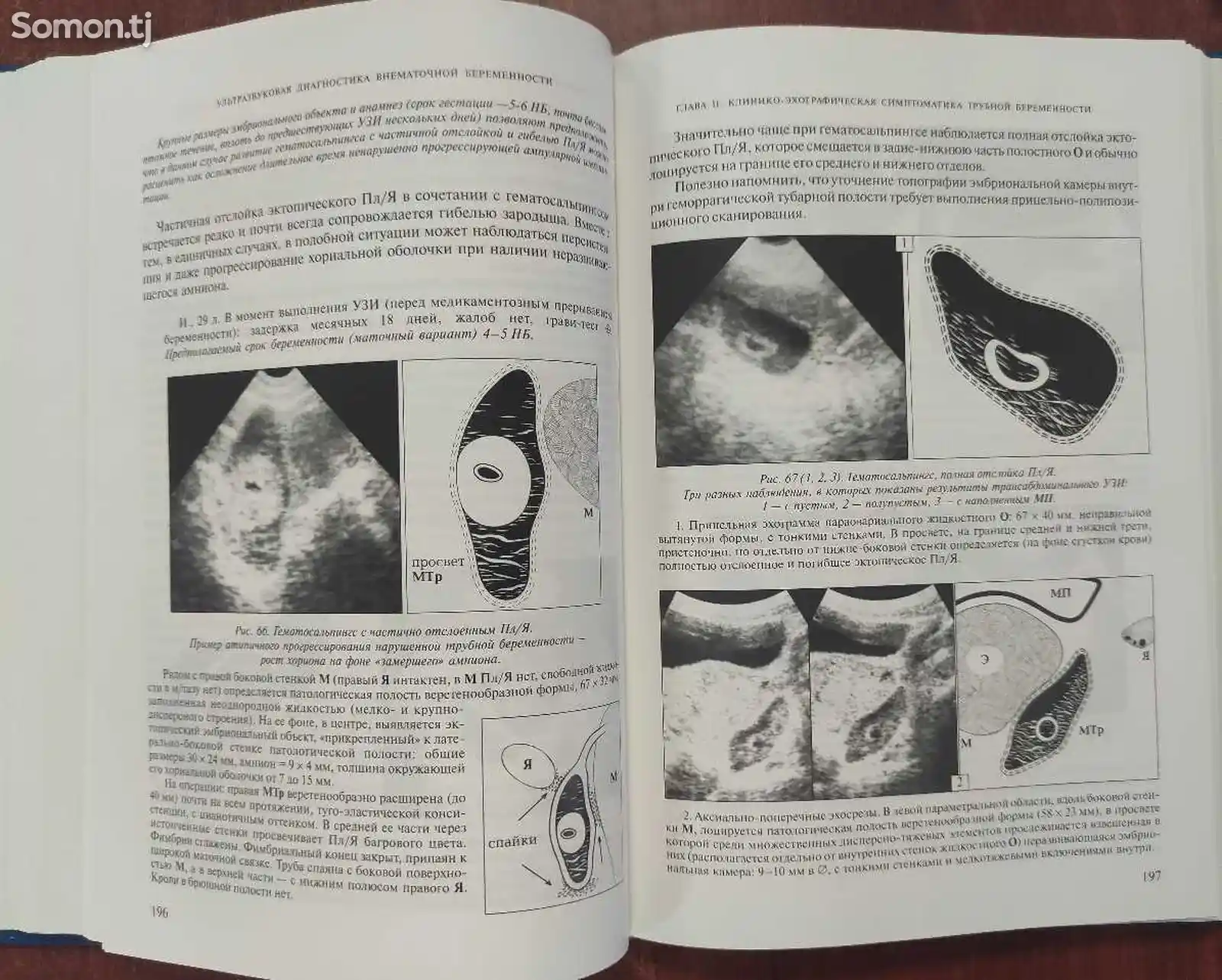 Ультразвуковая диагностика внематочной беременности-6