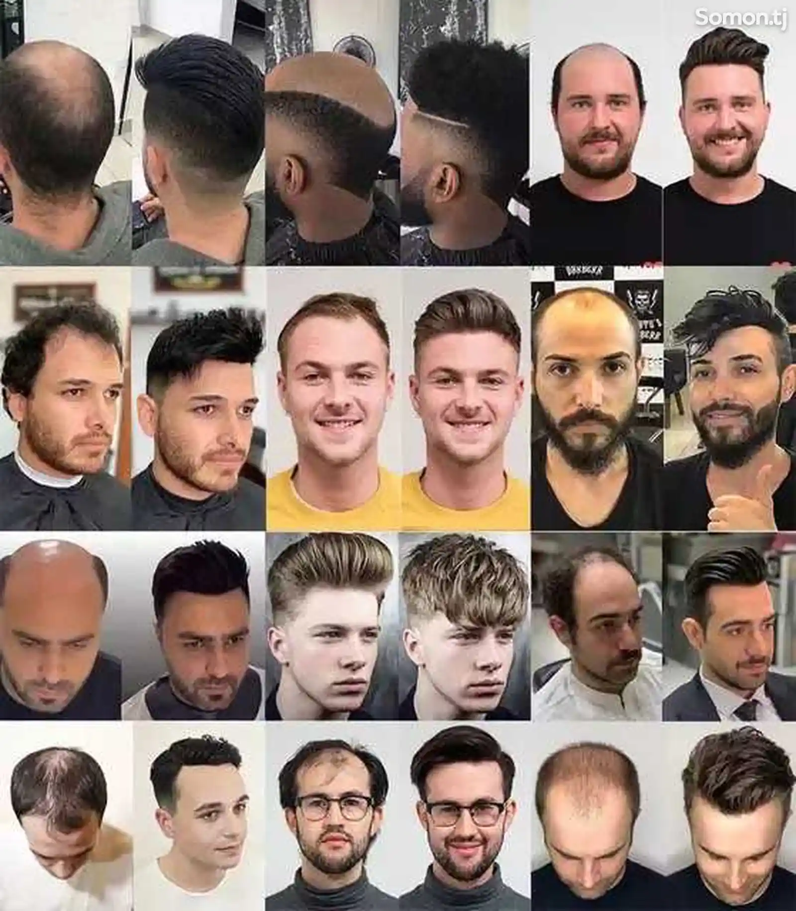 Услуга по наращиванию волос для мужчин-11