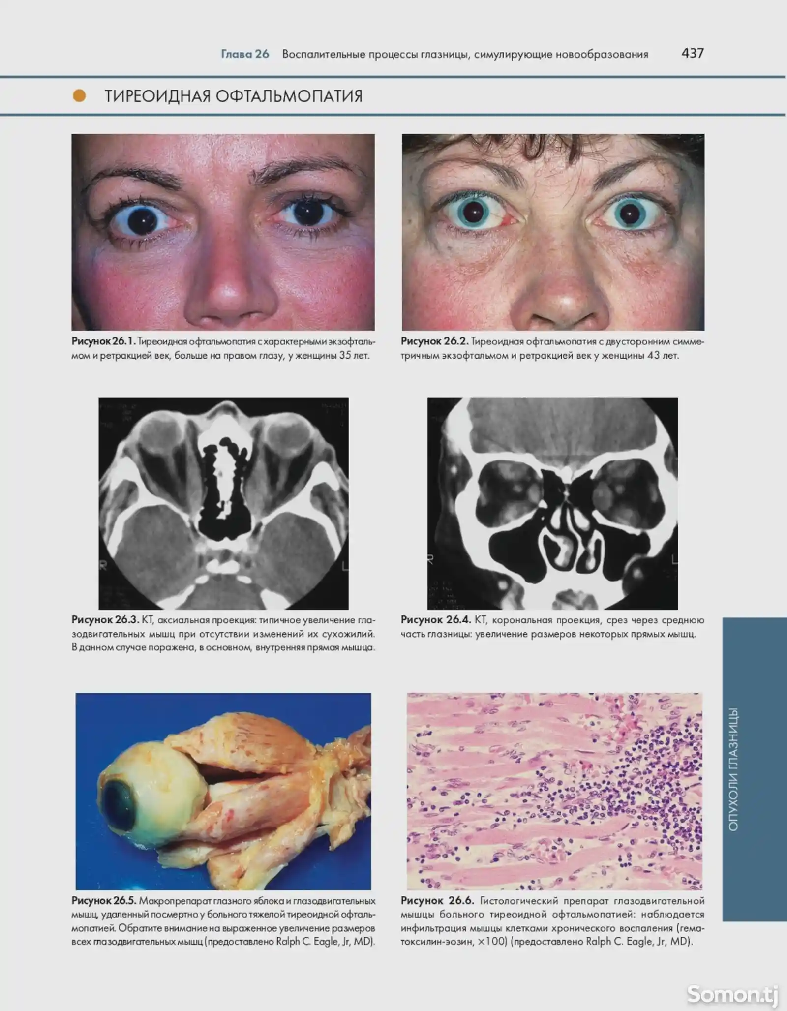 Атлас и справочник Опухоли век конъюнктивы и глазницы-7