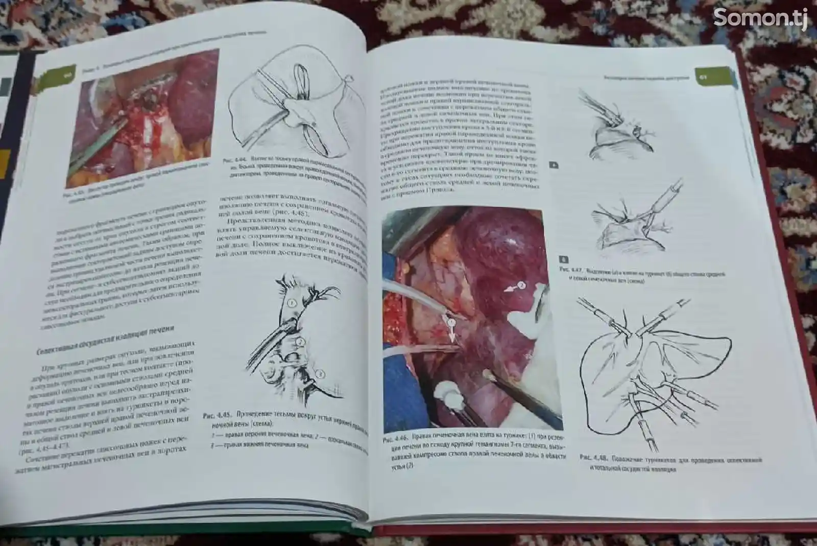 Книга атлас операций печени и поджелудочной железы-5