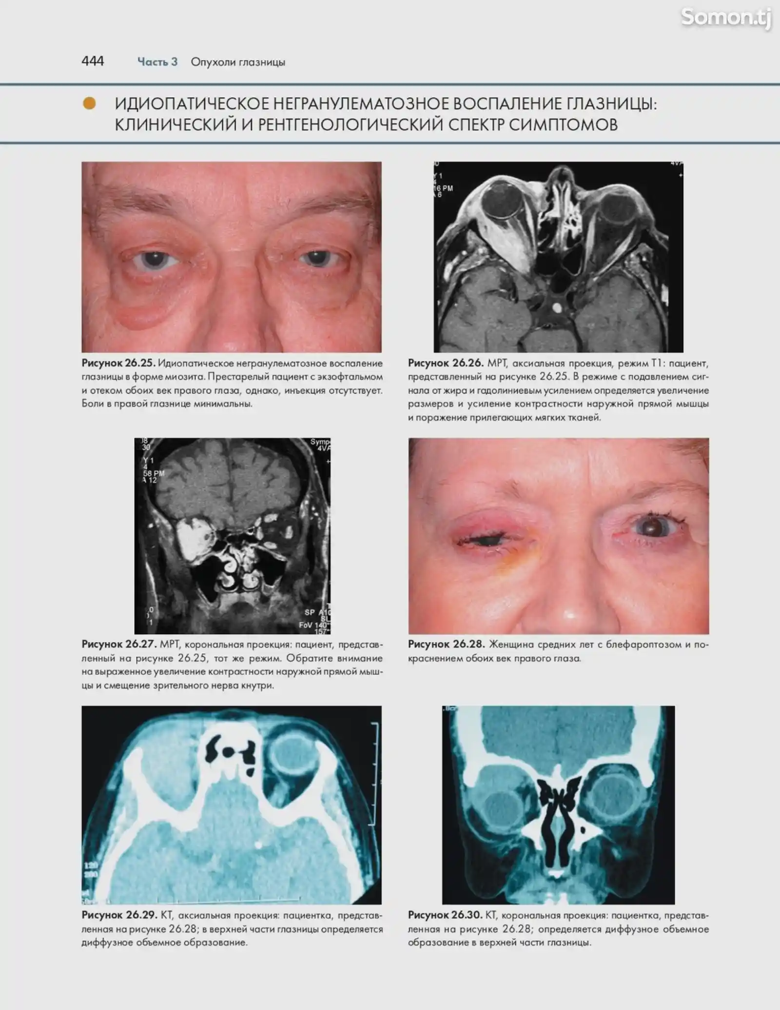 Атлас и справочник Опухоли век конъюнктивы и глазницы-14