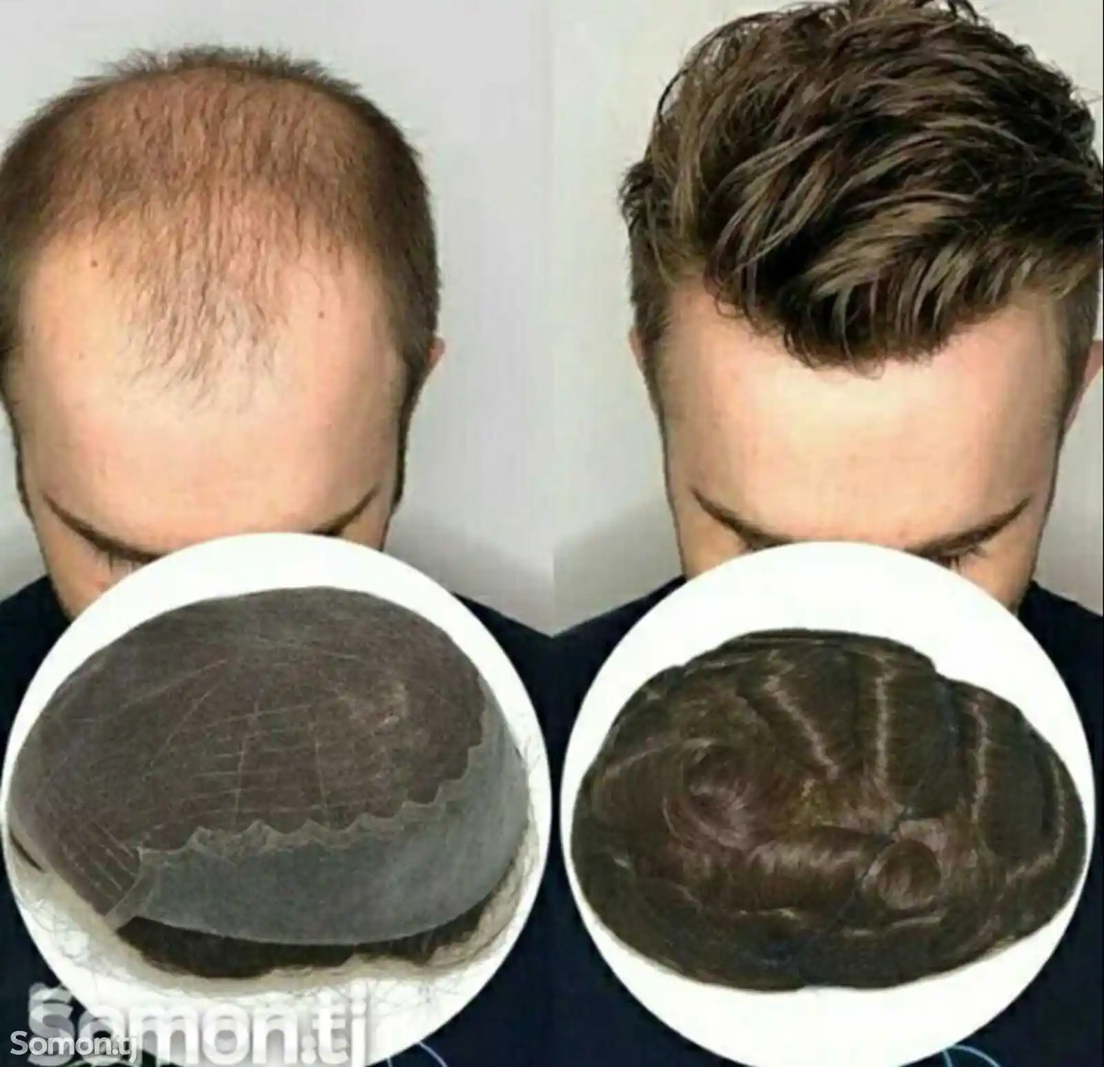 Услуга по наращиванию волос для мужчин-1