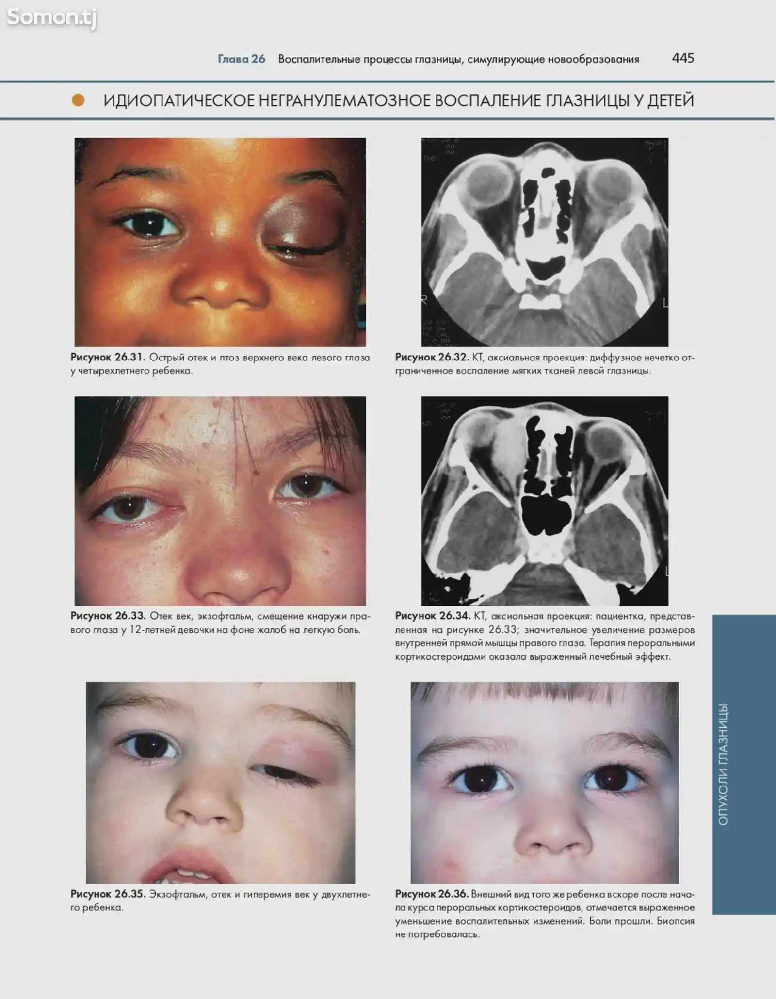 Атлас и справочник Опухоли век конъюнктивы и глазницы-15