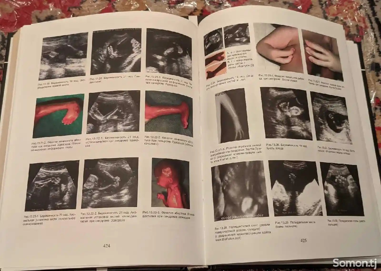 Книга Ультразвуковая диагностика в акушерстве и гинекологии-6